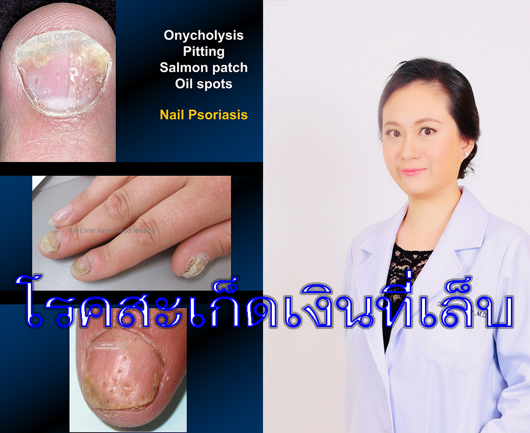 Nail Disorders: Clues to Systemic Disease - ppt video online download
